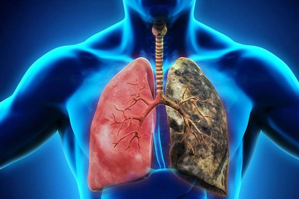 Bệnh ung thư phổi giai đoạn cuối là tình trạng nguy hiểm đối với nhiều người